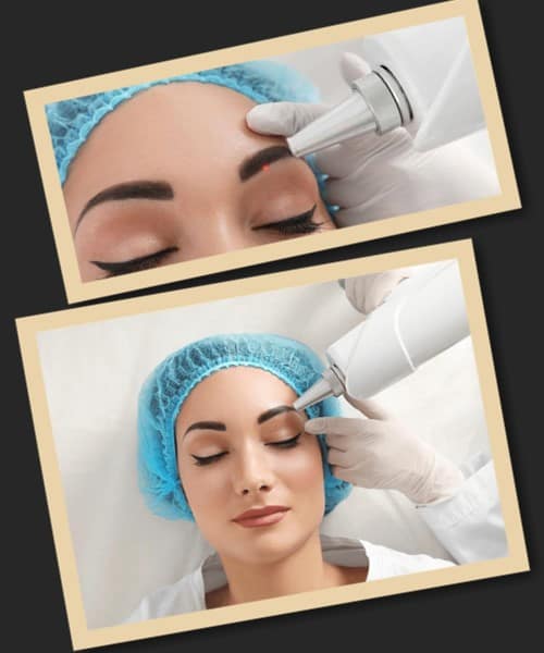 ефективність лазерної обробки татуажу