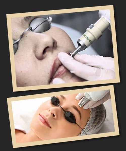 методи для видалення татуажу