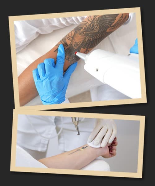 Лазерне видалення татуювань: протипоказання