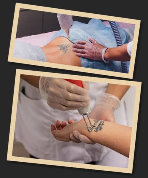 протипоказання до видалення тату