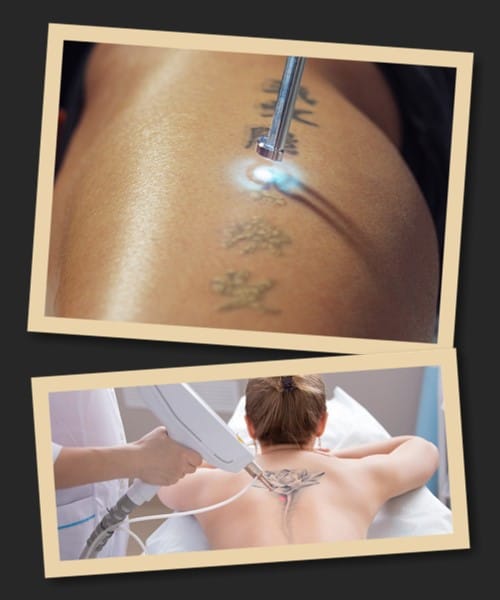 видалити тату лазером
