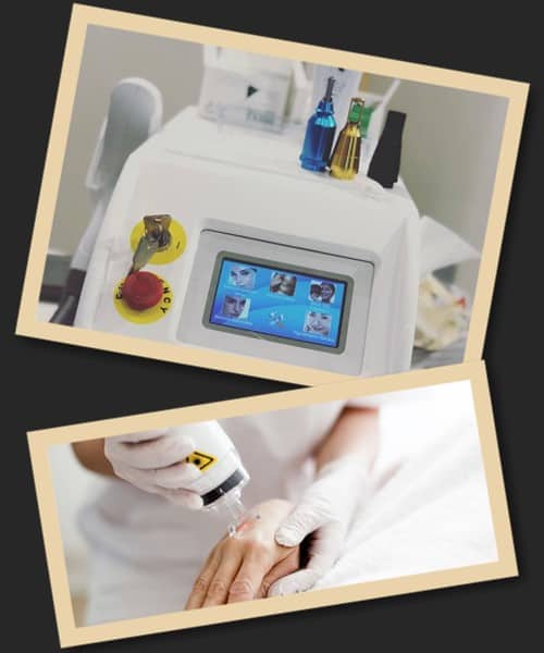 коли не можна видаляти тату лазером