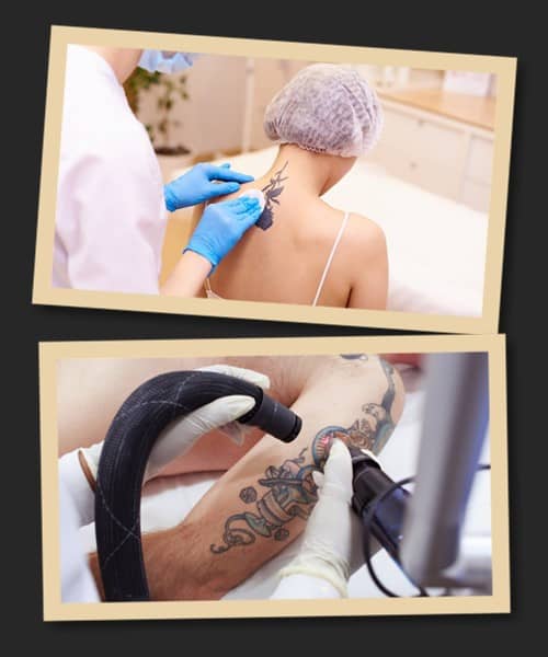 лазерне видалення тату протипоказання