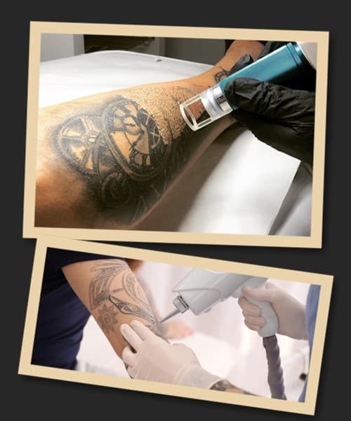 Лазерне видалення тату