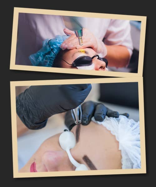 Чому варто обрати лазер для видалення татуажу