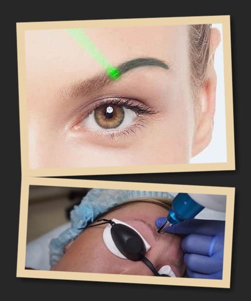 лазерне видалення татуажу брів