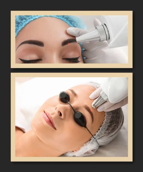 лазерне видалення татуажу брів ціна в Києві