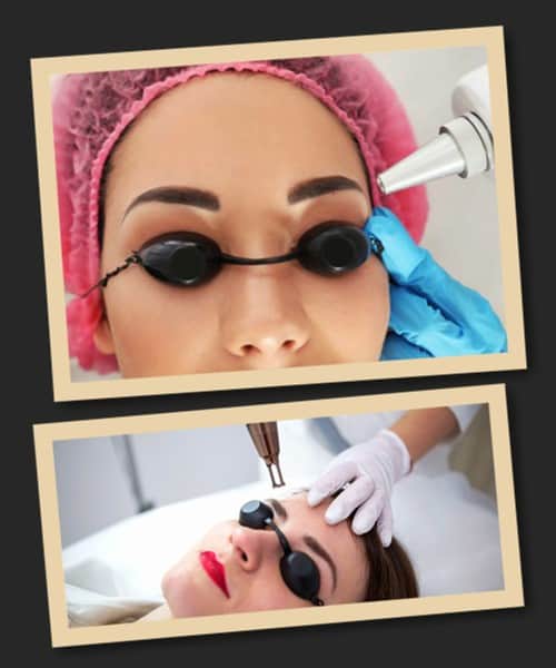 Тривалість курсу лазерного видалення татуажу