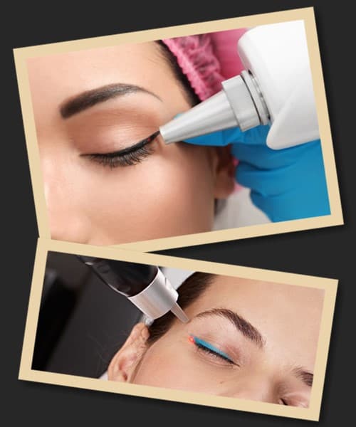 Лазерне видалення татуажу повік