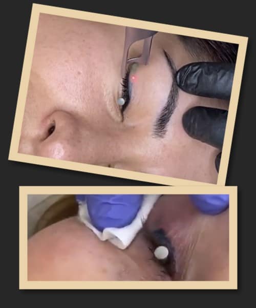 Чому лазер кращий за ремувер?