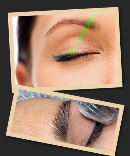 лазерне видалення татуажу повік