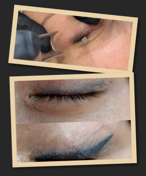 видалити татуаж повік