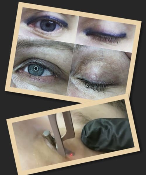 Лазерне видалення татуажу повік