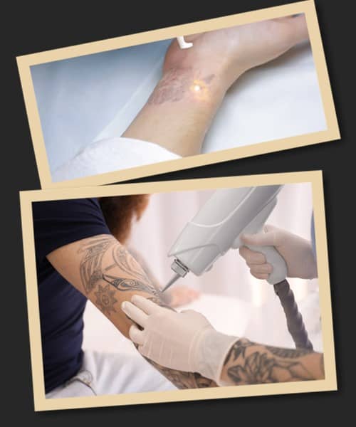 переваги лазерного методу видалення тату