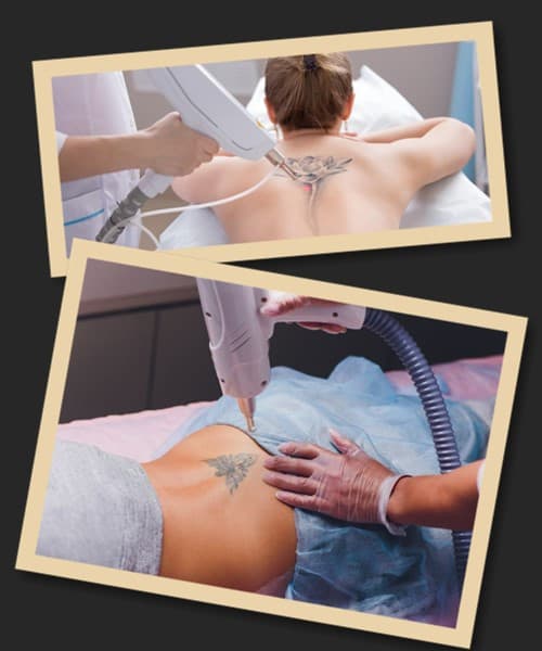 процедура лазерного виведення тату