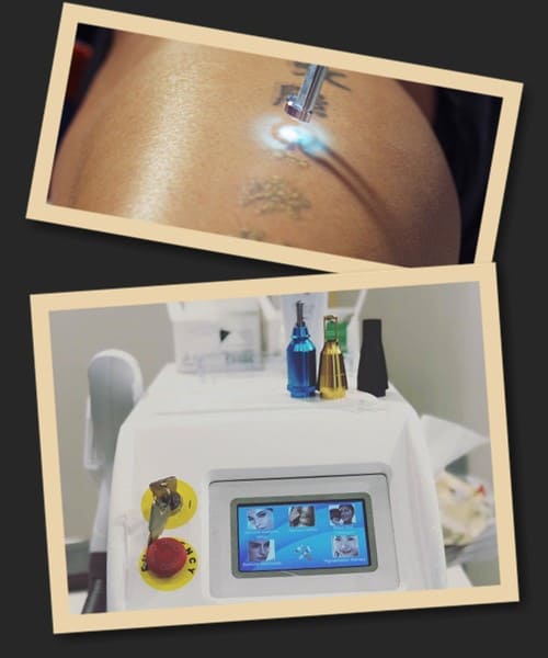 Nd yag laser видалення татуювання