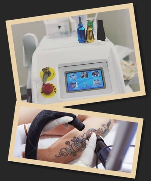 Видалення татуювань неодимовим лазером у Києві