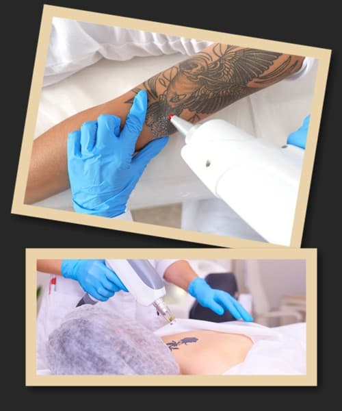 Плюси лазерної технології видалення тату