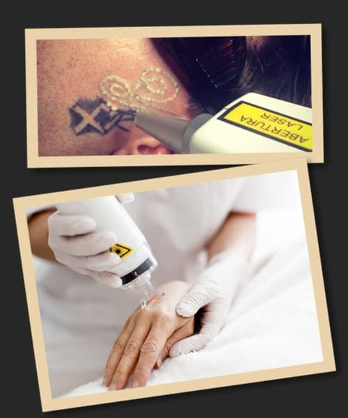 видалення перманентних зображень з тіла