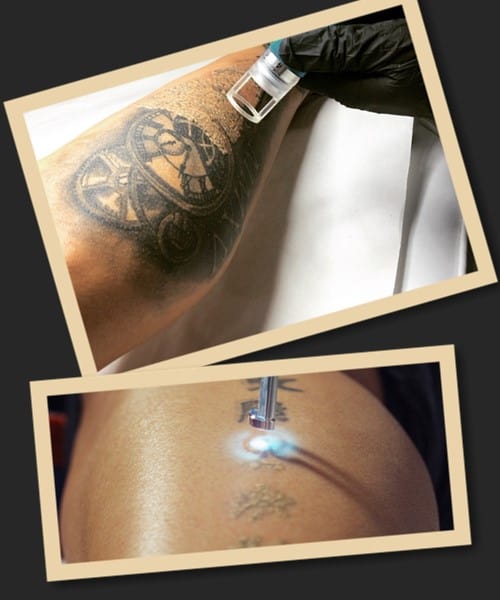 Переваги неодимового приладу для видалення тату