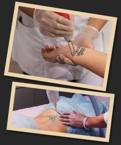 видалення тату Київ