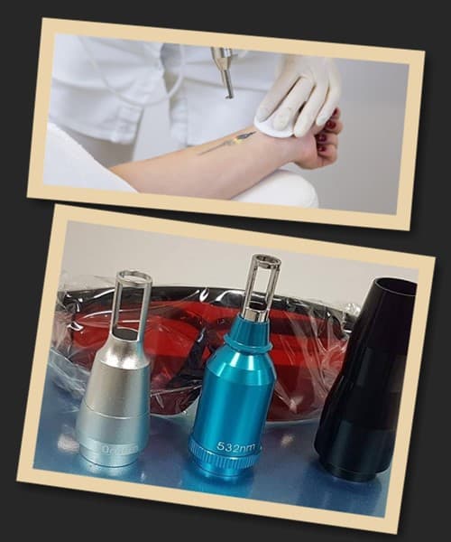 неодимовий лазер видалення тату Київ