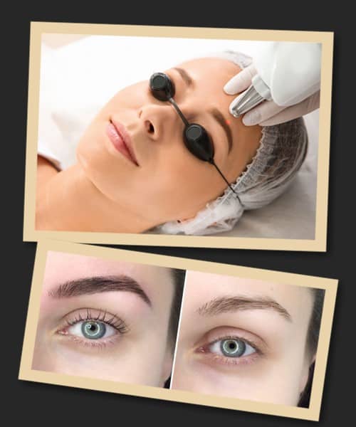 Наслідки лазерного видалення татуажу