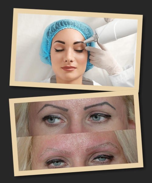 набряк після лазерного видалення татуажу