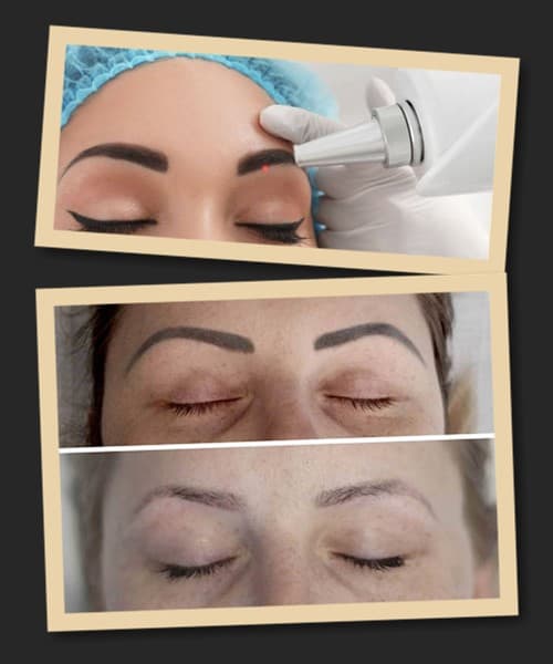 Наслідки лазерного видалення татуажу