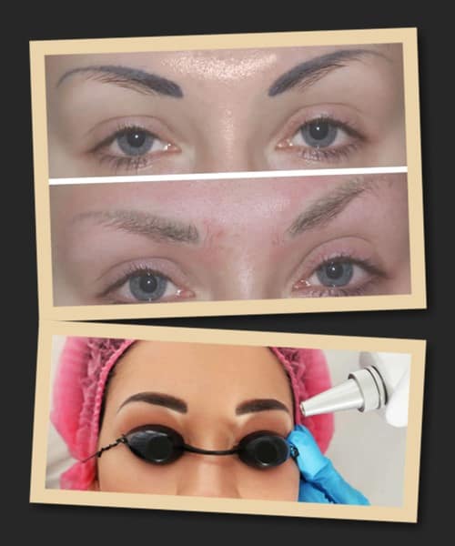 зведення татуажу лазером