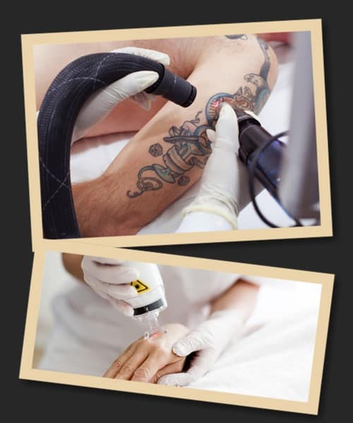 Пікосекундний лазер видалення тату