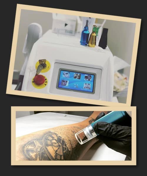 неодимовый лазер удаление тату