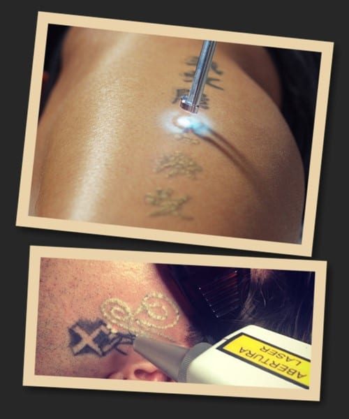 PicoSure видалення тату