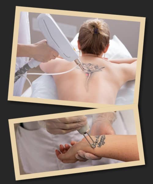 Лазер PicoSure видаляє тату