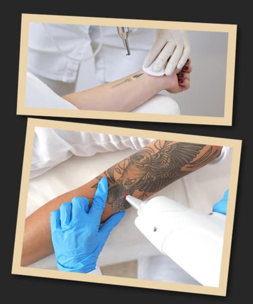 Видалення татуювань лазером picosure