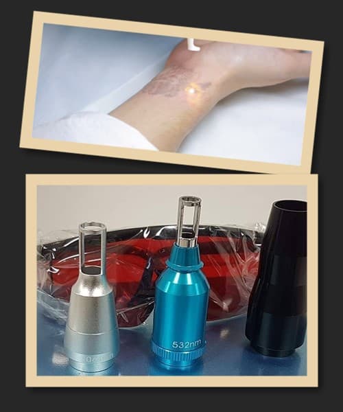 видалити татуювання