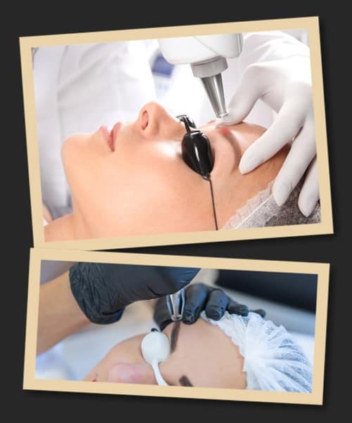 Як видалити татуаж?