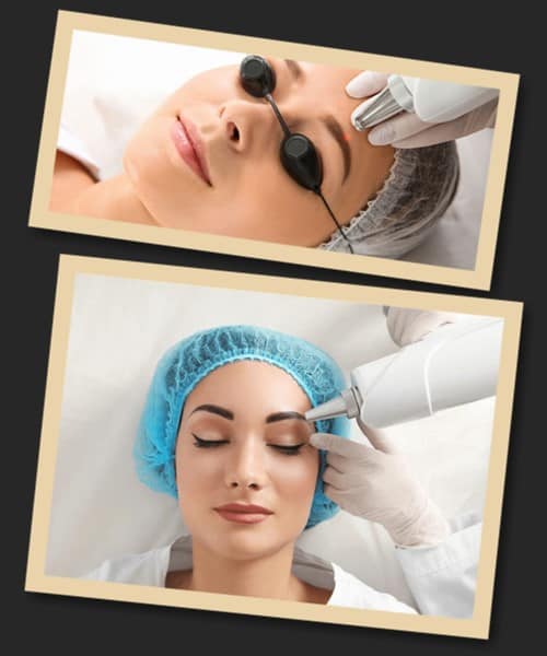 після лазерного видалення татуажу брів