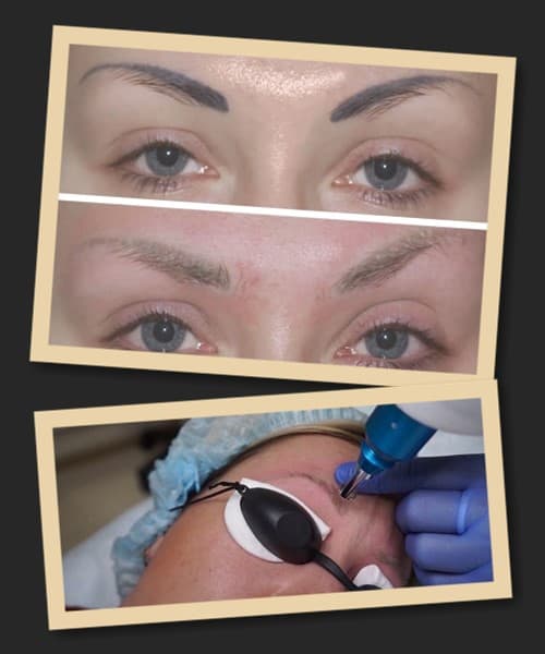 Видалити татуаж брів