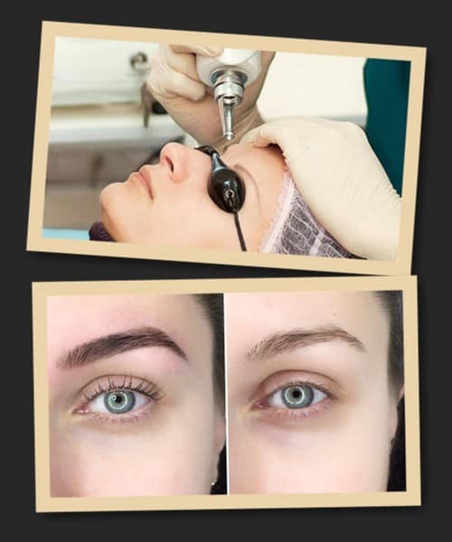 видалити татуаж брів