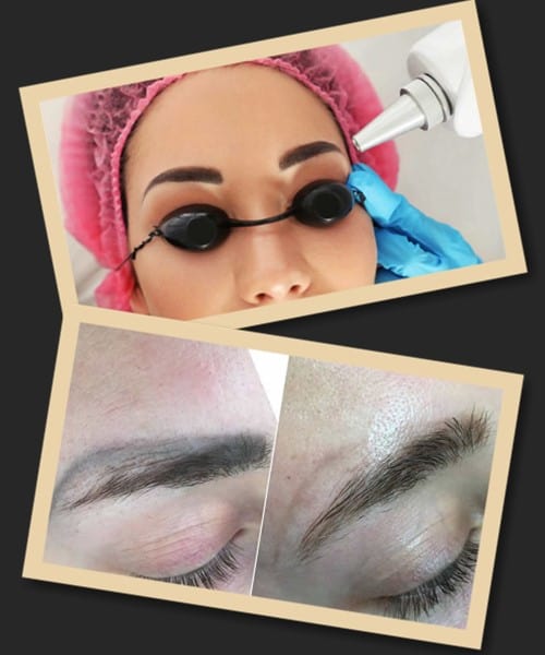 Лазерне видалення татуажу