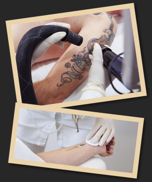 Лазерне видалення татуювань