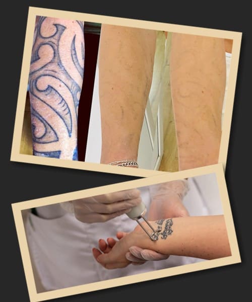 догляд після видалення тату