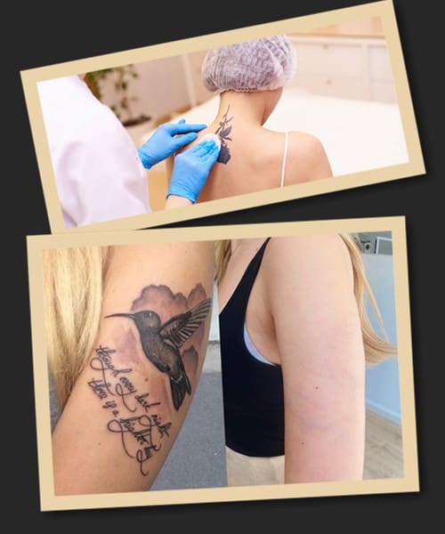 Як можна звести тату?