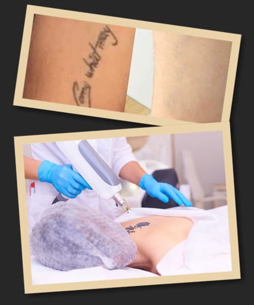 після видалення тату лазером