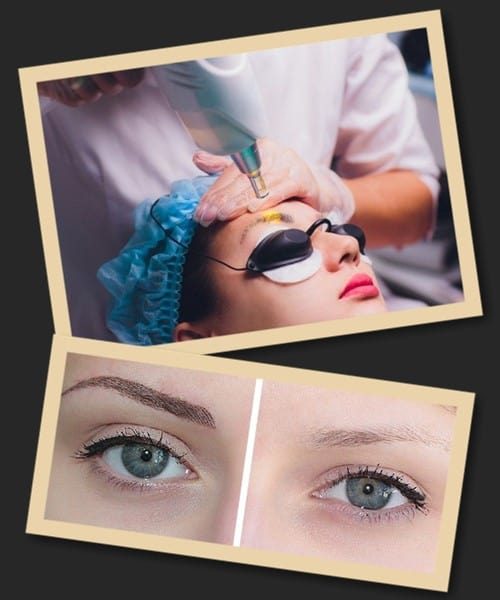 Брови після лазерного видалення татуажу