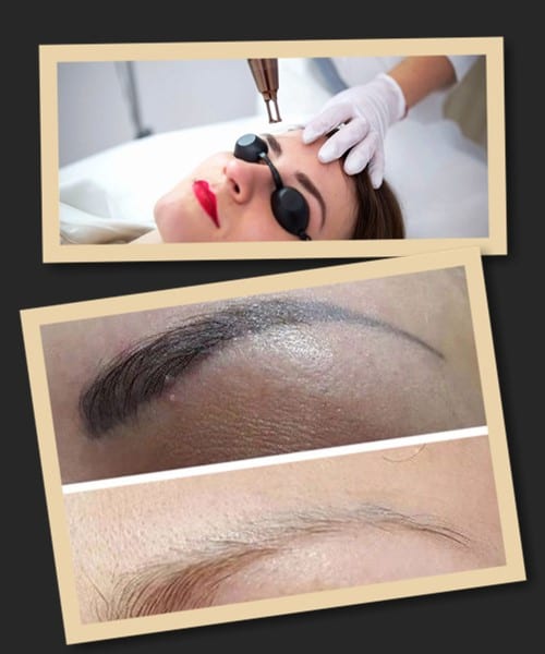 лазерне видалення татуажу