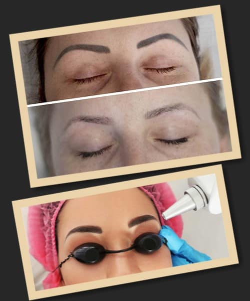 Негативні наслідки після видалення перманенту