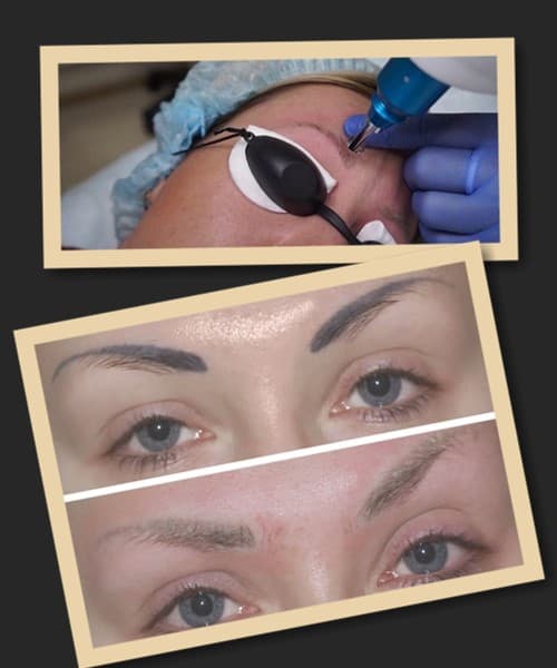 прибрати татуаж брів у Києві