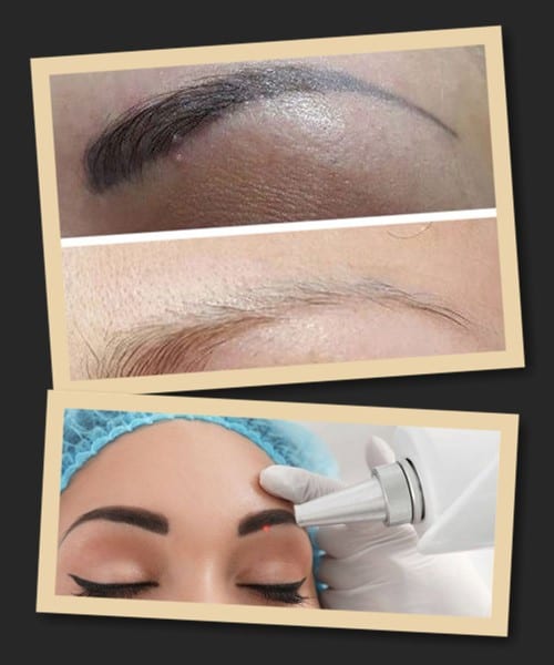 Методи видалення татуажу брів